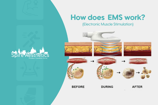 EMS treatment for post pregnancy weight loss treatment Bloxwich