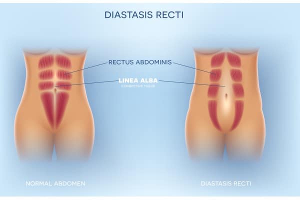 What Non-Surgical Options Are Available for Diastasis Recti Bloxwich?