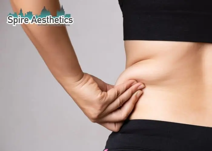 Image of woman pinching fat on their hips Bloxwich. Fat Freezing treatment 