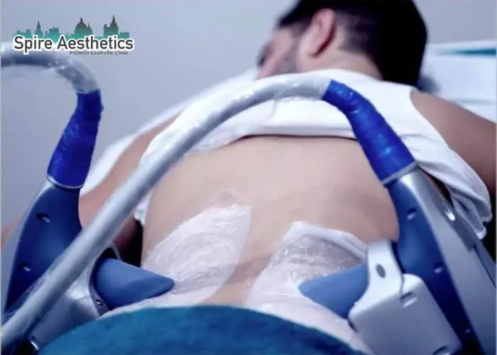 Man having fat freezing treatment done on love handles before a competitions Bloxwich to create a sculpted look.