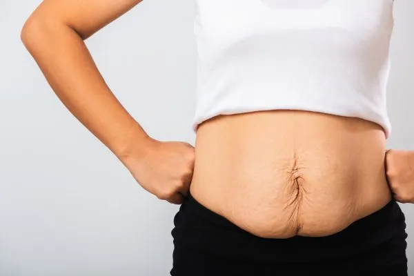 Image of a woman's stomach after weight loss with sagging skin following a gastric band Bloxwich