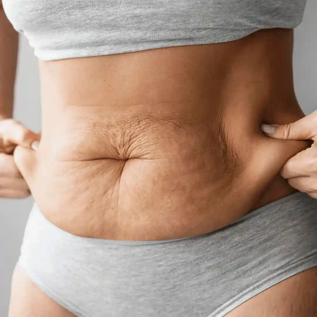 Is It Normal to Have Loose Skin After Pregnancy Bloxwich?