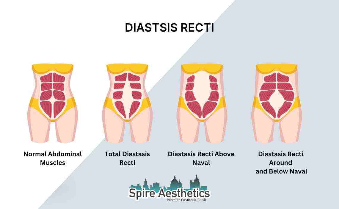 Is Non-Surgical Diastasis Recti Treatment Right for You? Common Concerns Answered Bloxwich